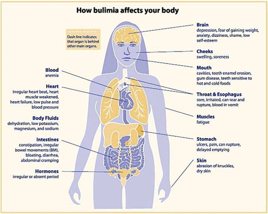 symptoms of bulimia